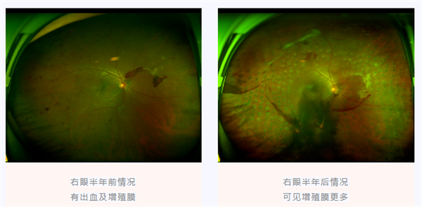 糖尿病視網(wǎng)膜病變